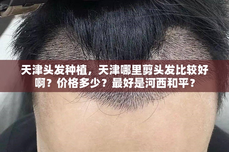 天津头发种植，天津哪里剪头发比较好啊？价格多少？最好是河西和平？