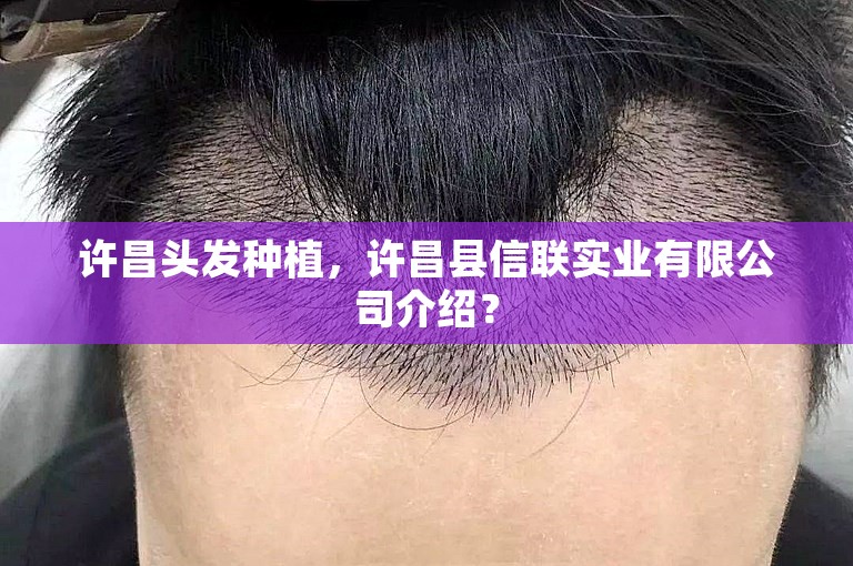 许昌头发种植，许昌县信联实业有限公司介绍？
