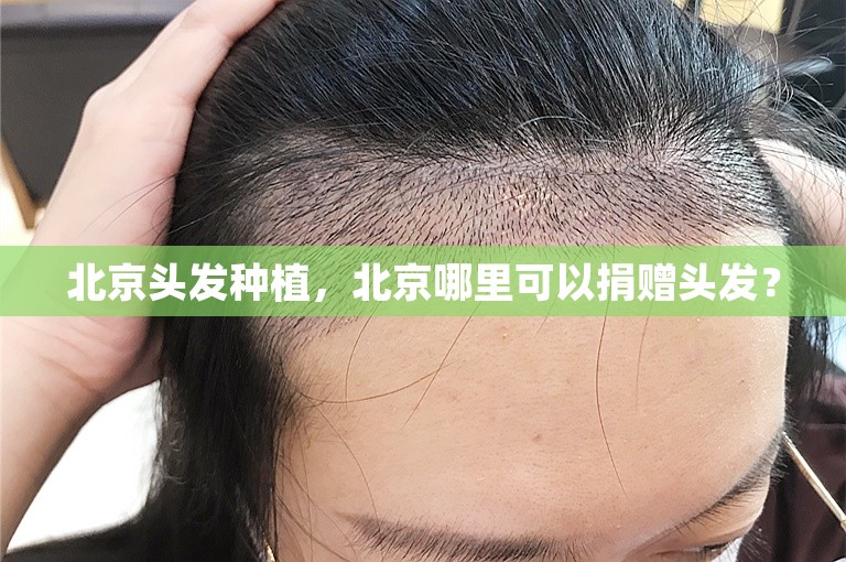 北京头发种植，北京哪里可以捐赠头发？