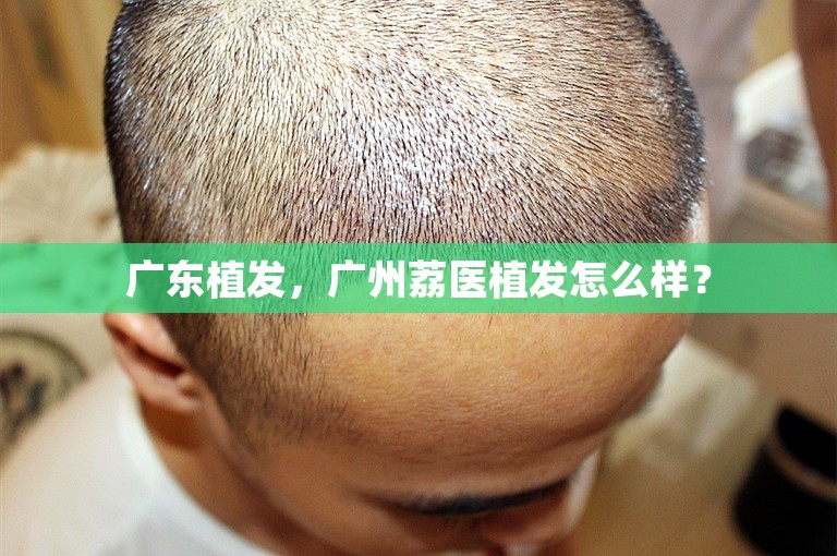 广东植发，广州荔医植发怎么样？