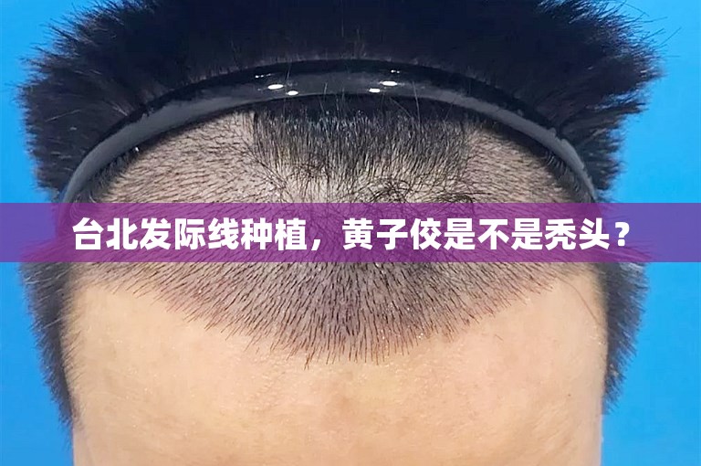 台北发际线种植，黄子佼是不是秃头？