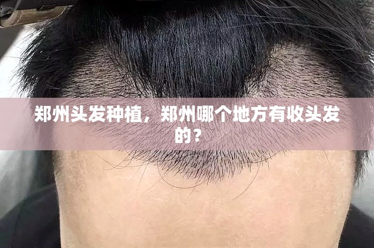 郑州头发种植，郑州哪个地方有收头发的？