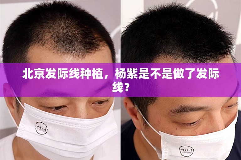 北京发际线种植，杨紫是不是做了发际线？