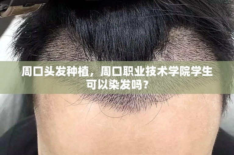 周口头发种植，周口职业技术学院学生可以染发吗？