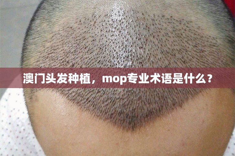 澳门头发种植，mop专业术语是什么？