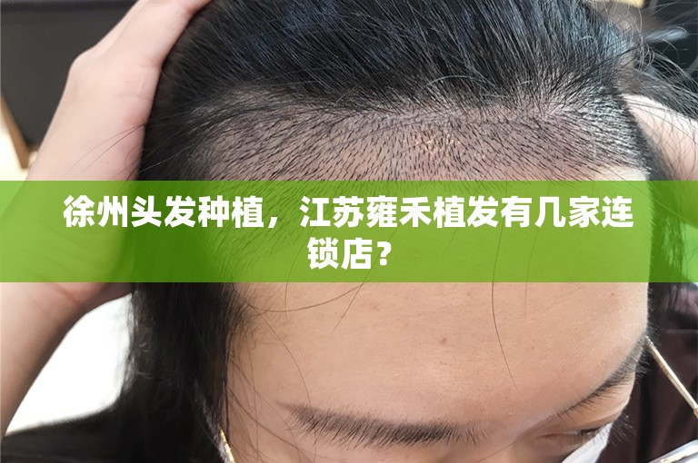 徐州头发种植，江苏雍禾植发有几家连锁店？