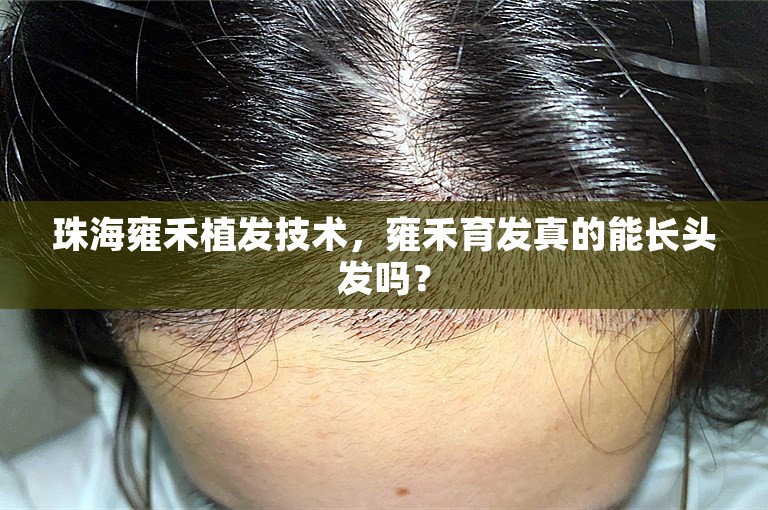珠海雍禾植发技术，雍禾育发真的能长头发吗？