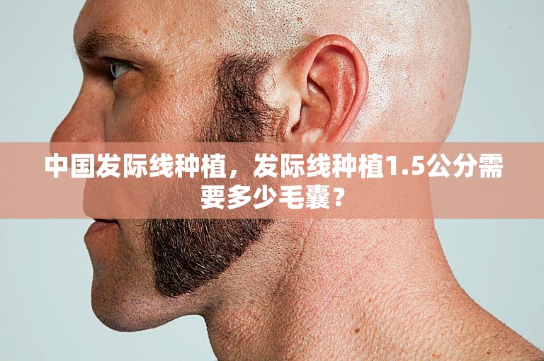 中国发际线种植，发际线种植1.5公分需要多少毛囊？