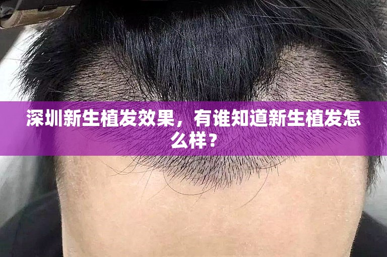 深圳新生植发效果，有谁知道新生植发怎么样？