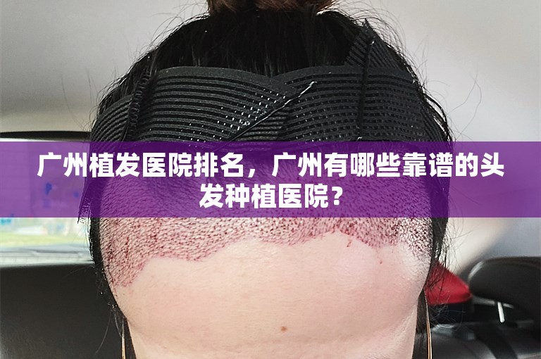 广州植发医院排名，广州有哪些靠谱的头发种植医院？